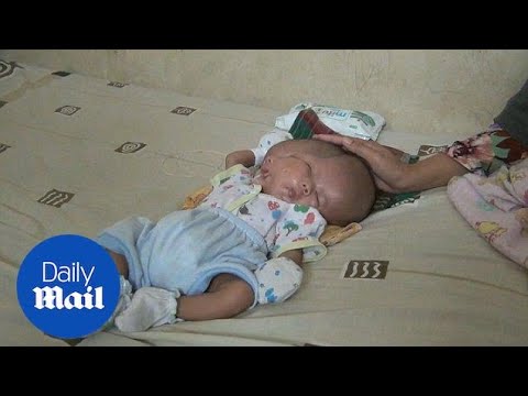 Baby in Indonesia born with two faces and two brains in one head
