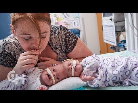 Conjoined Twins Abby and Erin Delaney: A Year in the Life