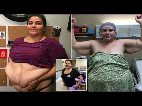 Women has 17LB Flap of Saggy Skin Removed | Weight loss
